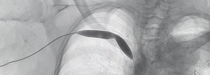 Percutaneous transluminal coronary angioplasty